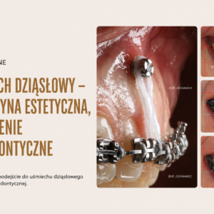 VOD: Uśmiech dziąsłowy - medycyna estetyczna, a leczenie ortodontyczne
