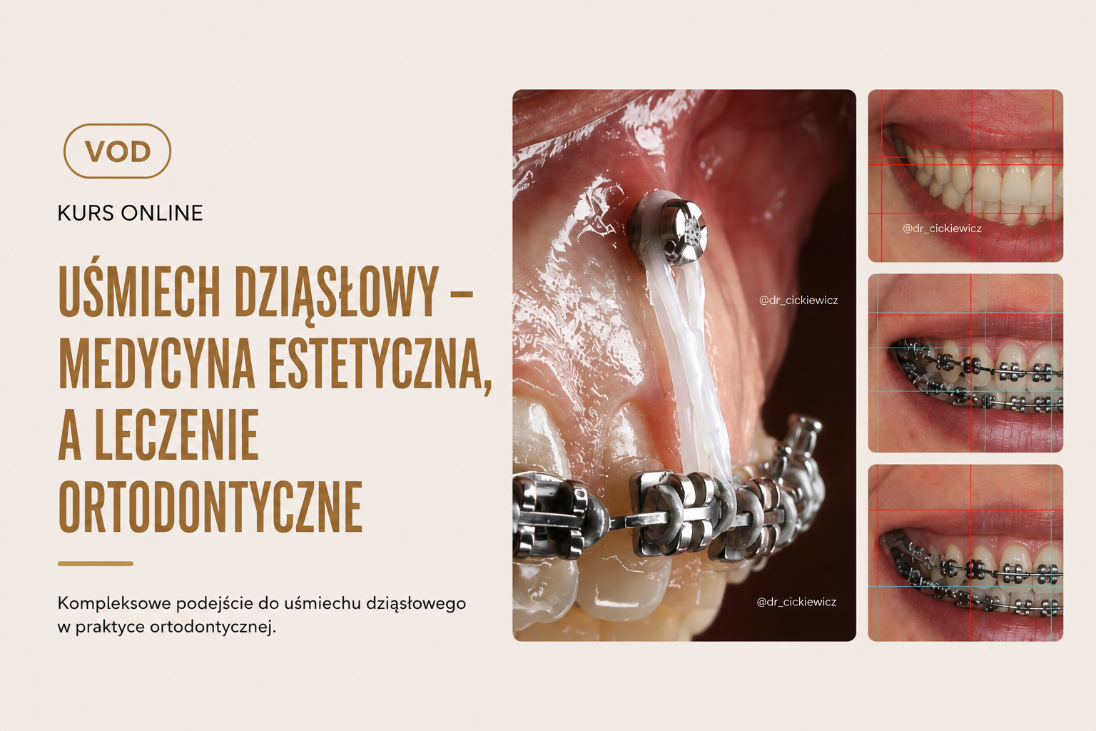 Uśmiech dziąsłowy – Medycyna estetyczna, a leczenie ortodontyczne